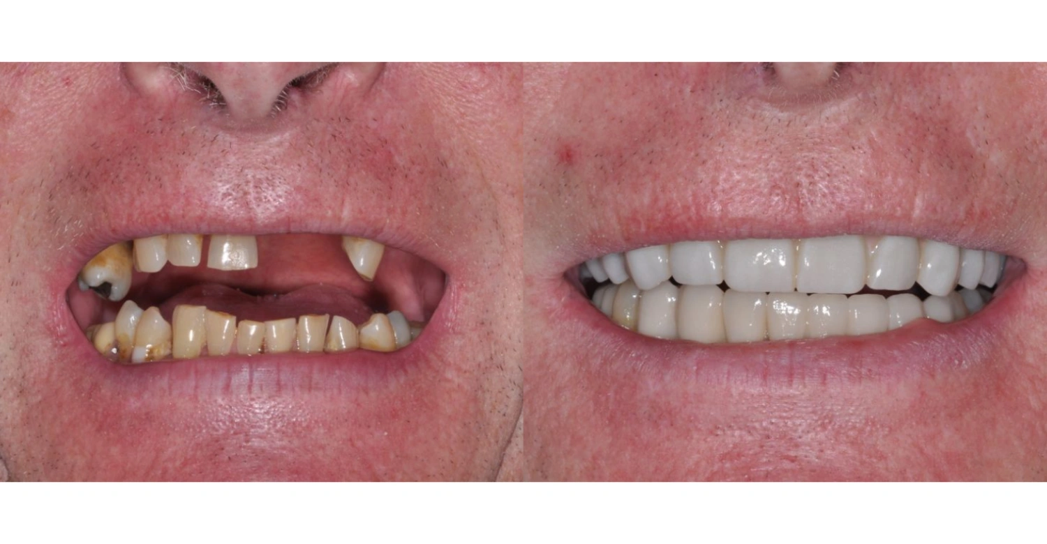 Tooth Agenesis inblog